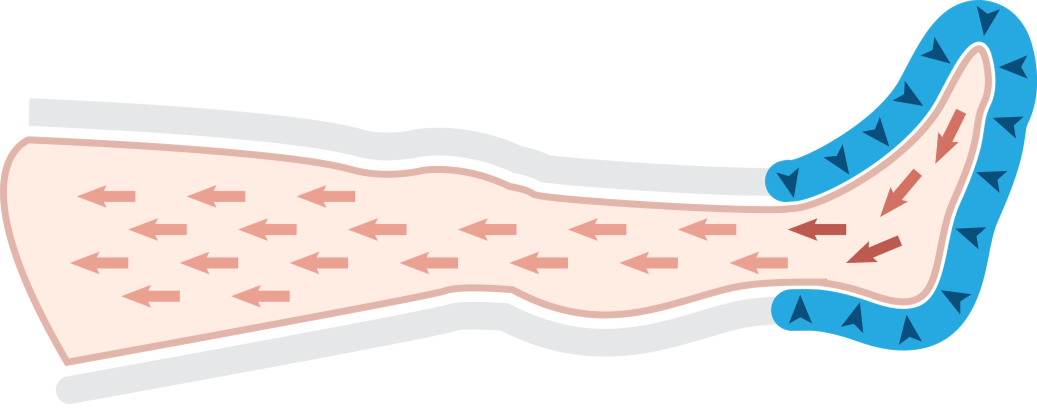 Intense Waves Mesis Pressoterapia Ad Uso Estetico Professionale E Domestico (1 Programma - 4 Camere D'aria + 2 Gambali + Kit Slim Body + 1 Bracciale) Cod. psg-iw-2gkb